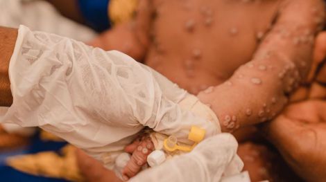 La OMS aprueba la primera vacuna contra el mpox