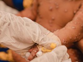 La OMS aprueba la primera vacuna contra el mpox